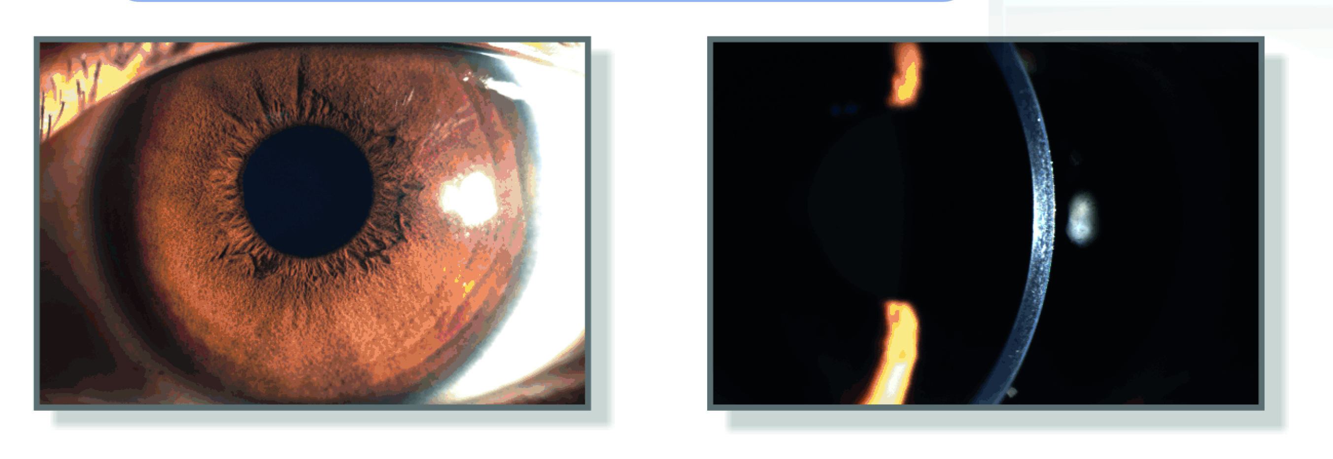 Lámpara de hendidura LS-7 LED